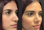 How the Best Doctors in Dubai Tailor Rhinoplasty to Your Face