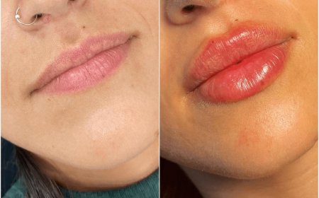 How Juvederm Treatments in Dubai Can Smooth Out Fine Lines