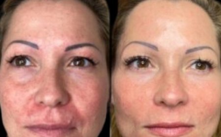 Revive Your Look with Profhilo from the Best Aesthetic Clinics in dubai