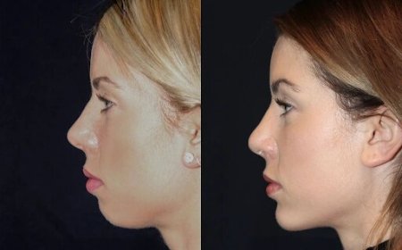 Best Aesthetic Clinics in dubai for Chin Fillers: A Solution for Weak Chin Definition