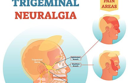 Managing the Pain of Trigeminal Neuralgia