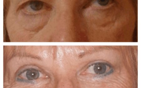 How to Choose Between Surgical and Non-Surgical Eye Bag Removal: Tips from the Best Eye bag removal Surgeons in Dubai