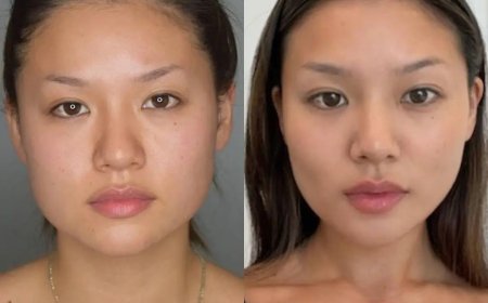 Creating Balanced Proportions with the Best Buccal fat removal Surgeons in Dubai