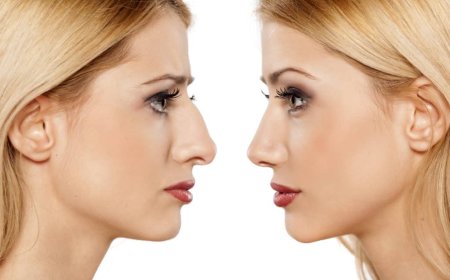 Rhinoplasty Dubai: How Safe is Rhinoplasty and What Are the Success Rates