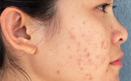Find Your Perfect Acne Treatment Match in Dubai