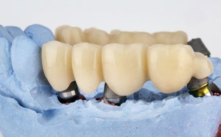 Everything You Need to Know About Dental Crowns and Their Benefits