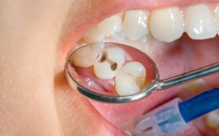 Je Glimlach als Visitekaartje: Alles over Tanden Bleken en Facings in Breda