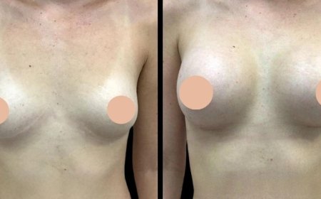Customized Surgical Plans from the Best Breast Augmentation Surgeon in Dubai