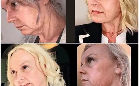 Drive Skin Perfection with Profhilo from Best Doctors in dubai