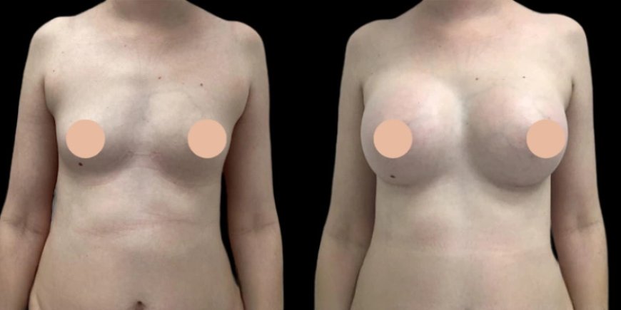 Expert Hands: Best Breast Augmentation Surgeon in Dubai Reviewed