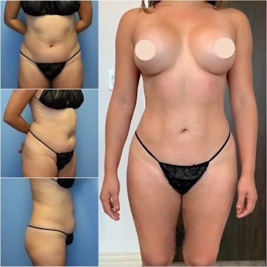 Sculpt Your Ideal Figure with the Best Body Contouring Surgeons in dubai