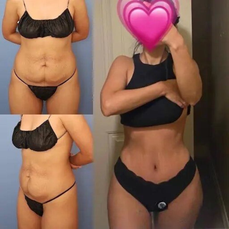 How the Best Tummy Tuck Surgeons in dubai Help You Achieve Your Ideal Body Shape