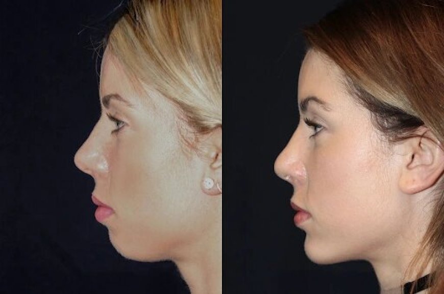 Best Aesthetic Clinics in dubai for Chin Fillers: A Solution for Weak Chin Definition