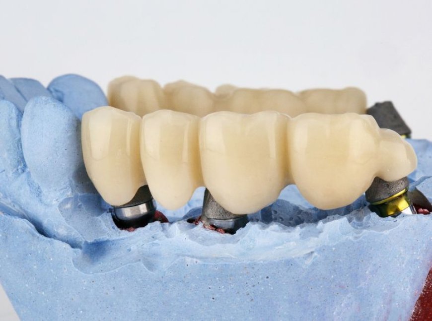 Everything You Need to Know About Dental Crowns and Their Benefits