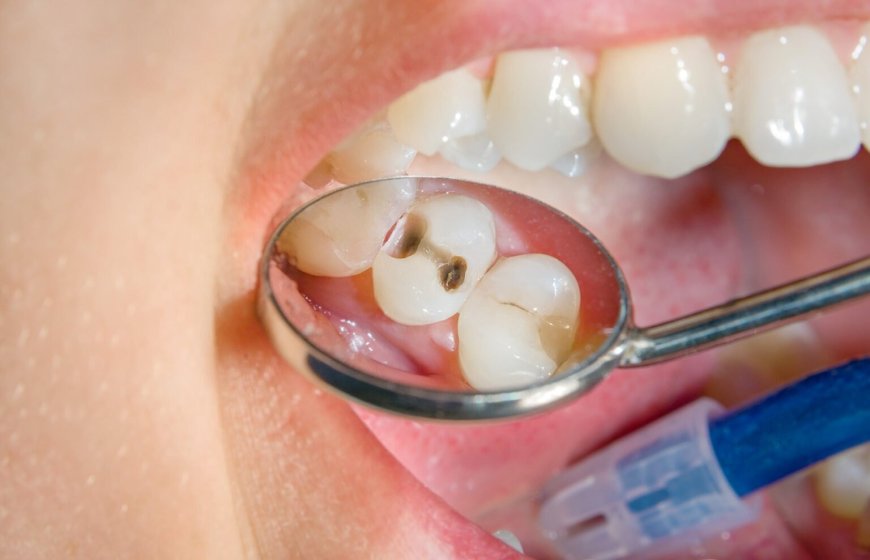 Je Glimlach als Visitekaartje: Alles over Tanden Bleken en Facings in Breda