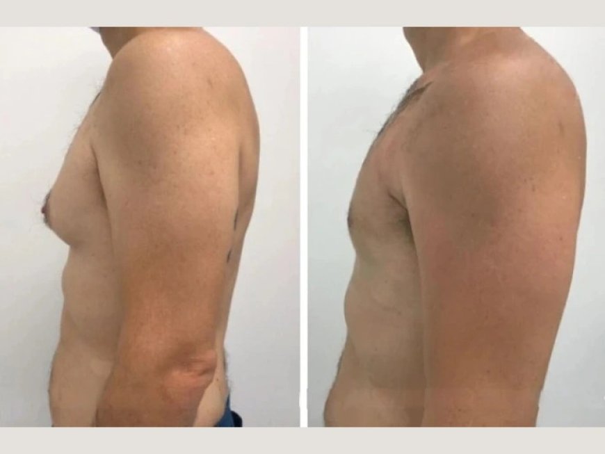 How to Achieve the Best Results with Gynecomastia in Dubai