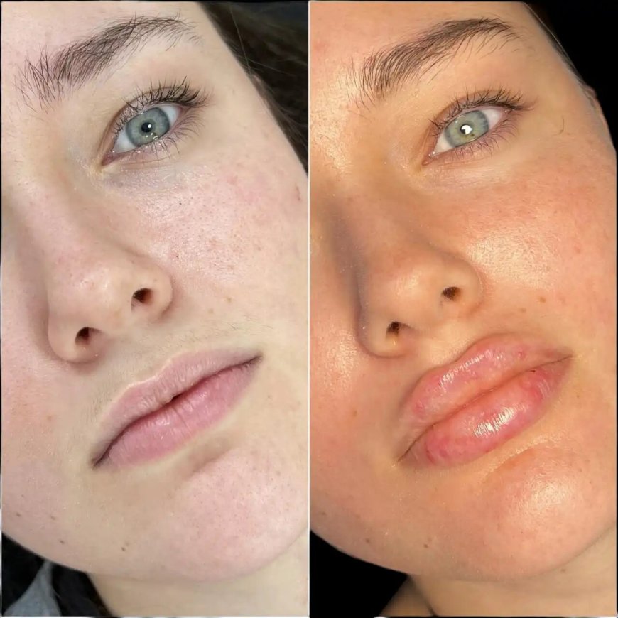 The Secrets to Perfect Russian Lip Fillers Contouring: Advice from Best Doctors in Dubai