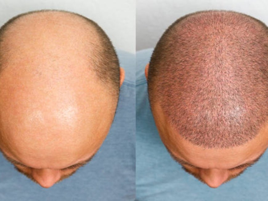 Transform Your Look with a Hair Transplant in Chennai