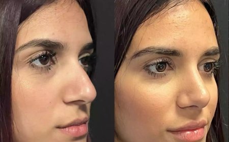Best Septoplasty Surgeon in Dubai: Reviews, Results, and Reputation