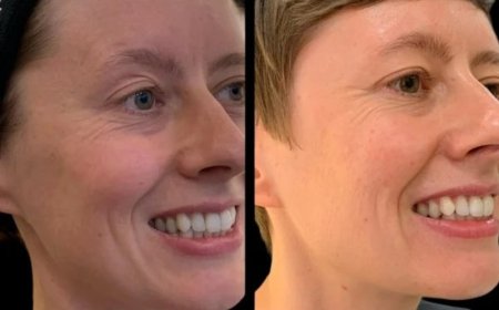 Manifest Youth with Profhilo by the Best Plastic Surgeon in dubai