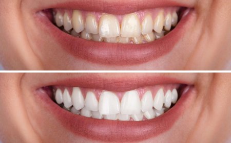 Business Guide to Teeth Whitening Shades
