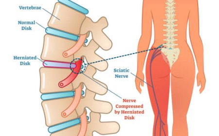 Aspadol 100 mg for Osteoarthritis Pain – Pros & Cons You Need to Know