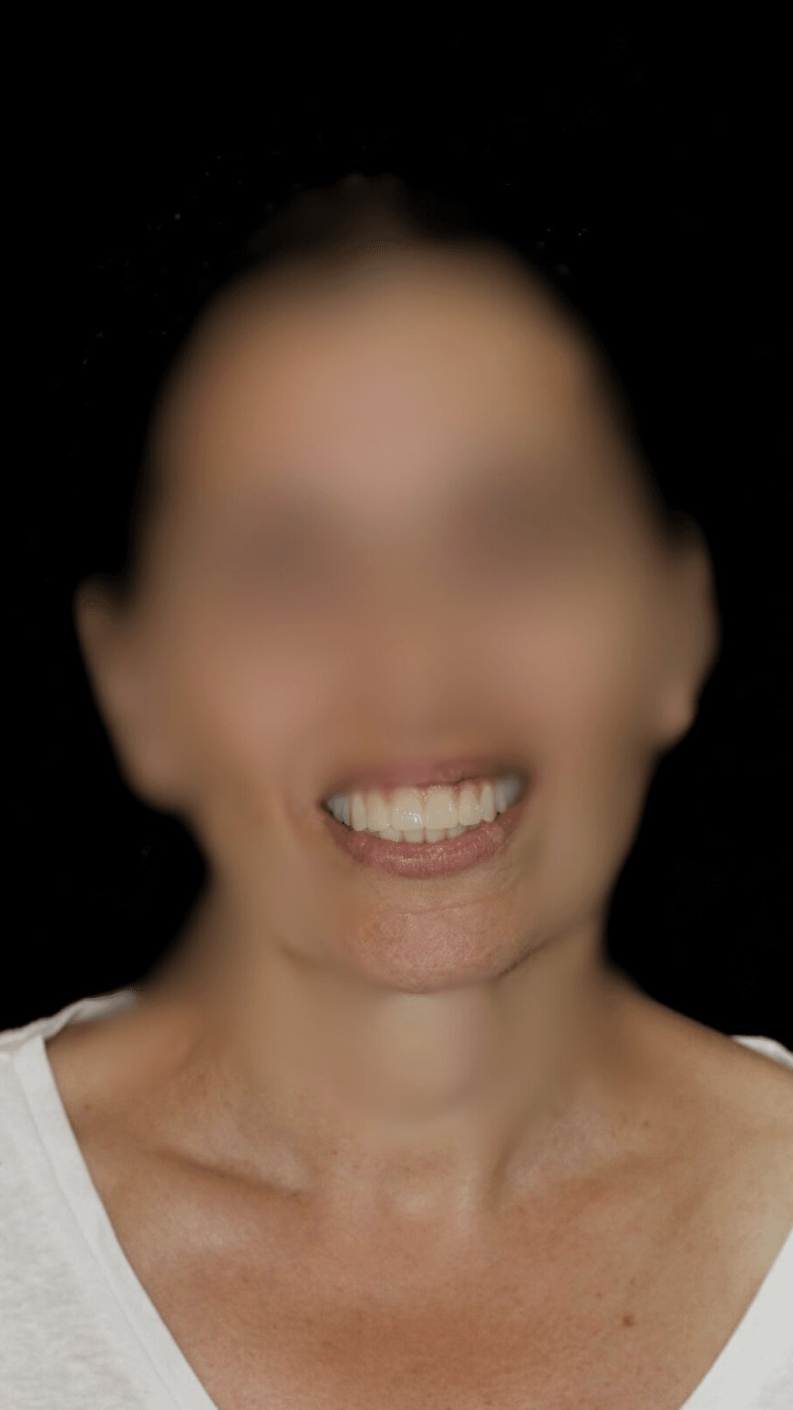 Implantes de Carga Inmediata en Hospitalet de Llobregat Tratamiento Rápido y Seguro