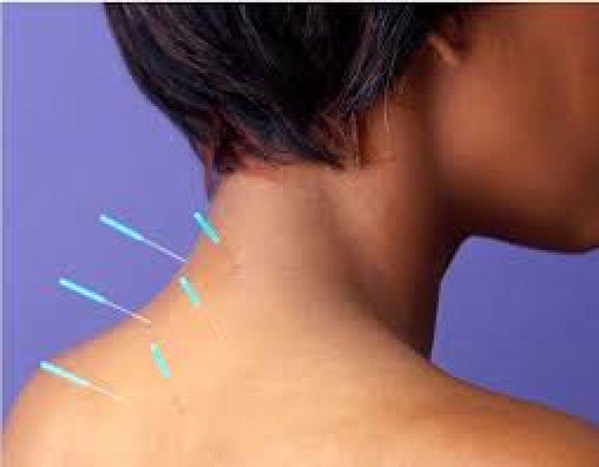 Things to Consider When Finding the Best Acupuncturist in Morristown